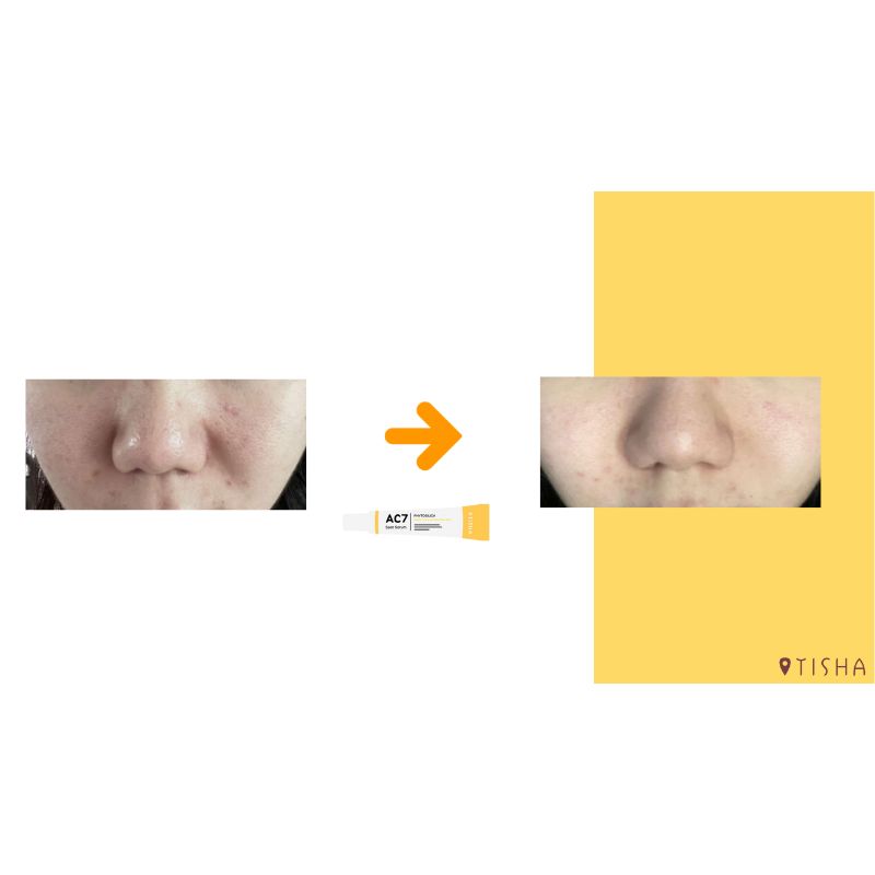 Крем за акне Dr. Tisha AC7