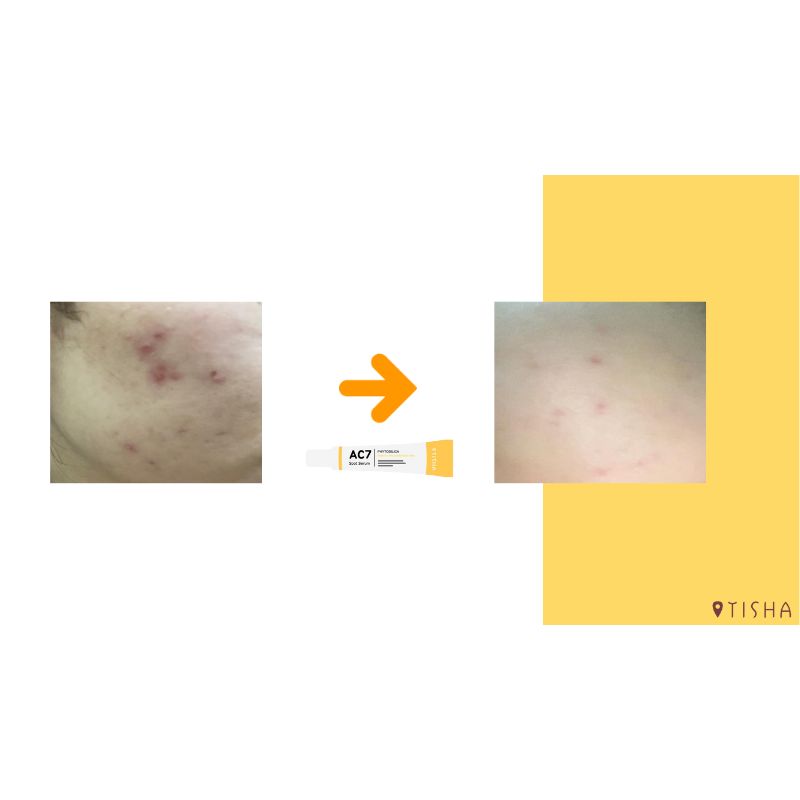 Крем за акне Dr. Tisha AC7