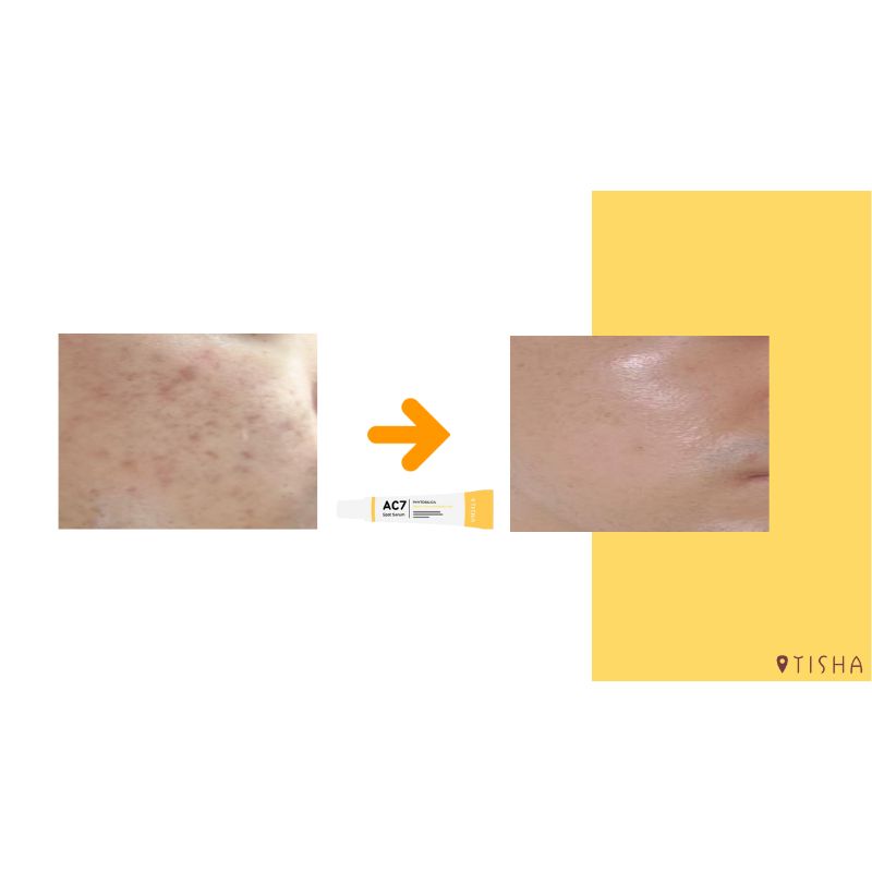 Крем за акне Dr. Tisha AC7