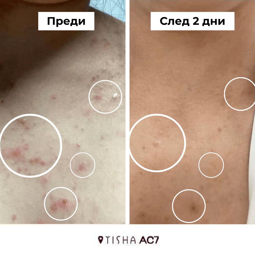 Крем за акне Dr. Tisha AC7