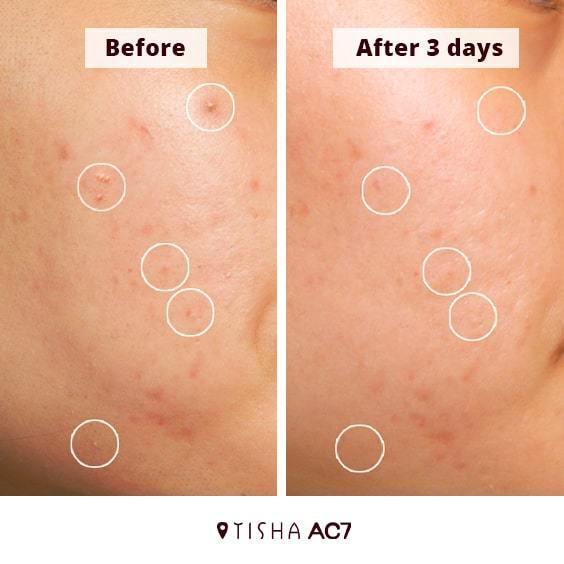 Крем за акне Dr. Tisha AC7