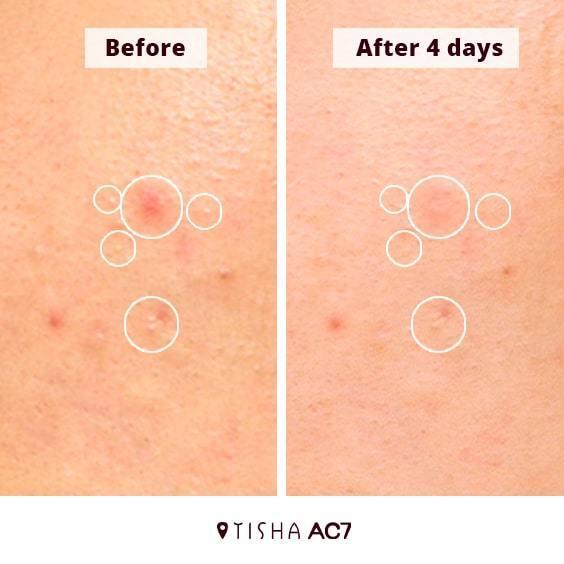 Крем за акне Dr. Tisha AC7