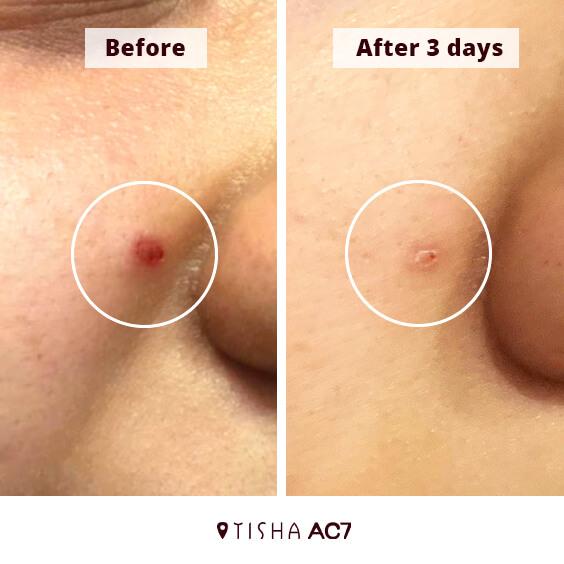 Крем за акне Dr. Tisha AC7