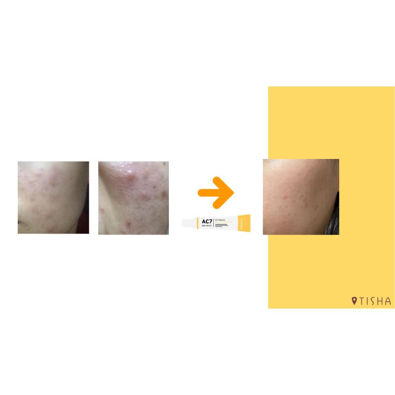 Крем за акне Dr. Tisha AC7
